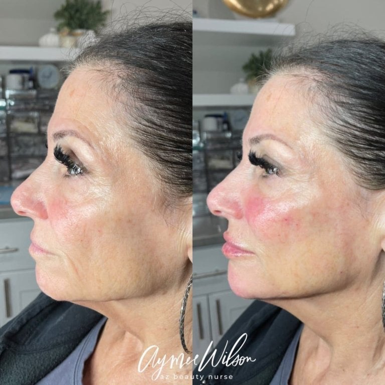 Dermal Fillers Prescott Valley, AZ Wilson Aesthetics