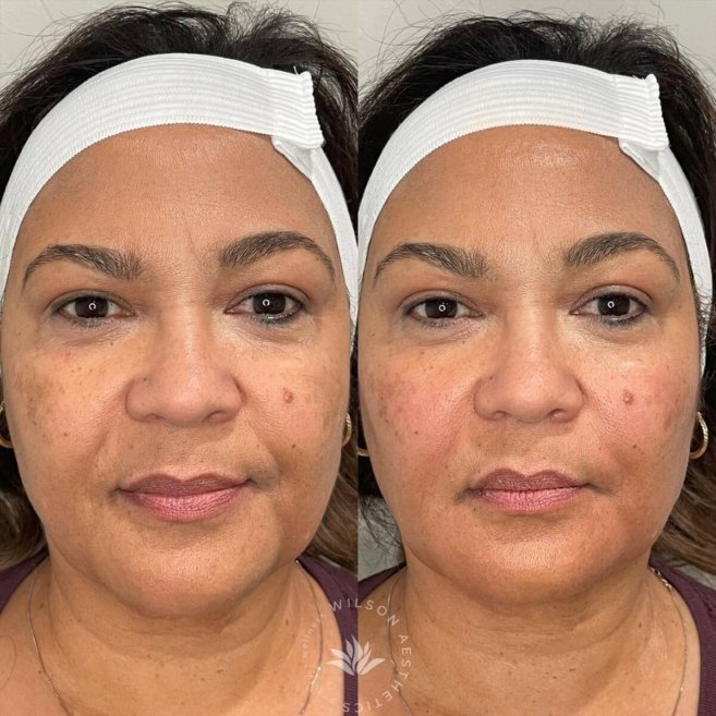 Sculptra Filler in Prescott Valley, AZ