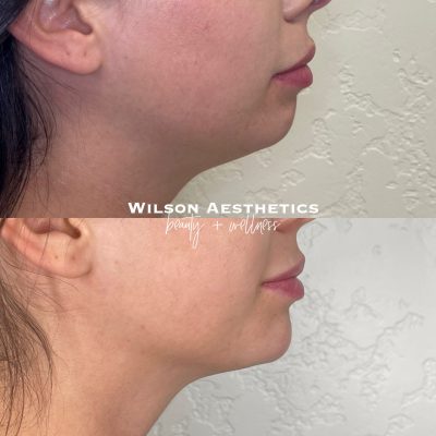 Chin Filler Before & After Image Dermal Fillers | Prescott Valley, AZ - Wilson Aesthetics
