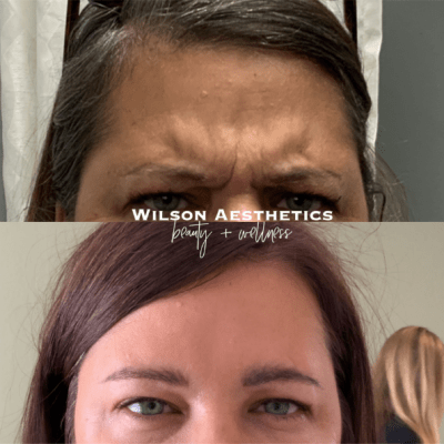 Botox/Dysport at Wilson Aesthetics at Prescott Valley, AZ