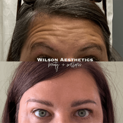 Botox/Dysport at Wilson Aesthetics at Prescott Valley, AZ