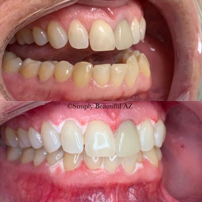 Teeth treatment before after images