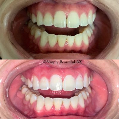 Teeth treatment before after images