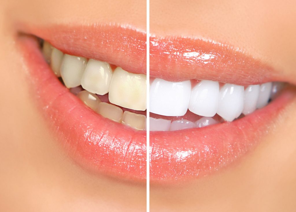 The Pros and Cons of Teeth Whitening Is It worth the price