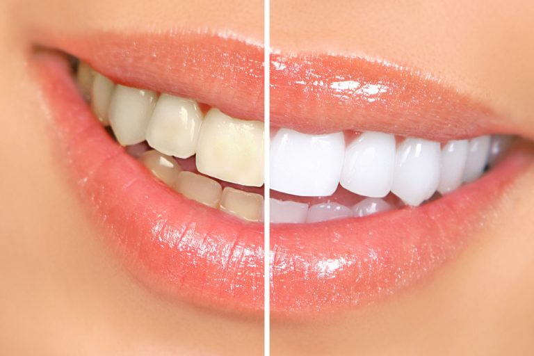 The Pros and Cons of Teeth Whitening: Is It worth the price?