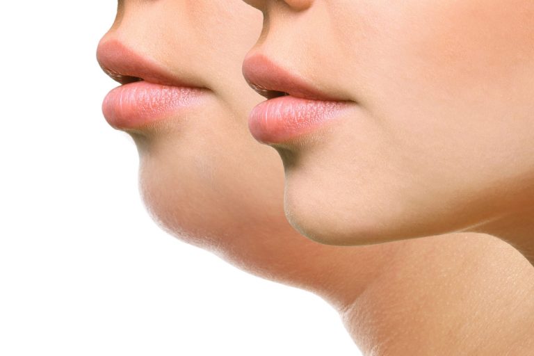 Is The Cosmetic Treatment Kybella As Effective As Lipo Under The Chin?