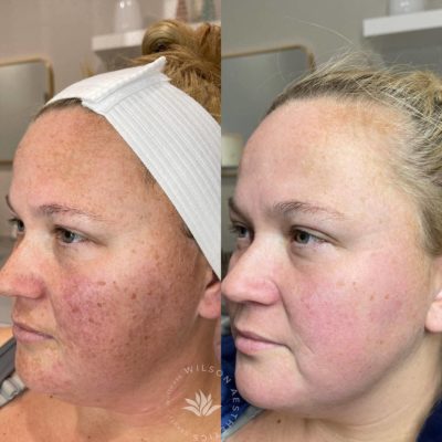 enlightenrxpeel Before and After Images