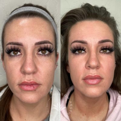 enlightenrxpeel Before and After Images
