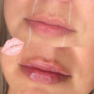 lipfiller Before and After Images