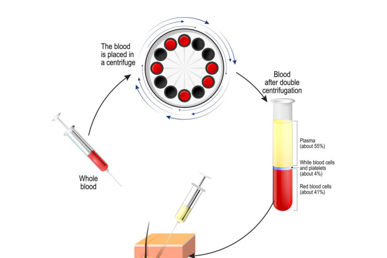 Platelet-rich Plasma: Is it effective for facial rejuvenation?