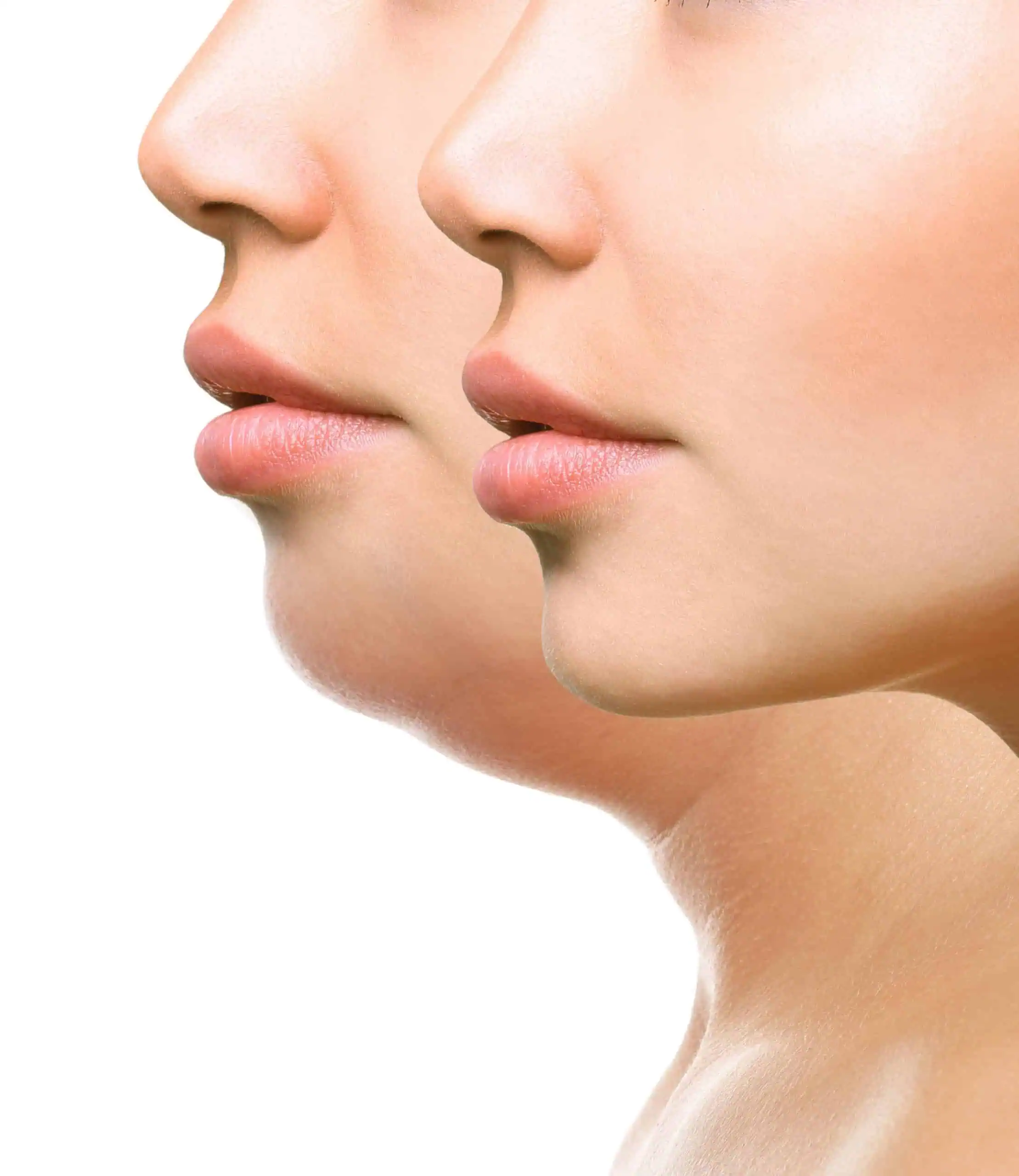 Cosmetic Treatment Kybella As Effective As Lipo Under The Chin