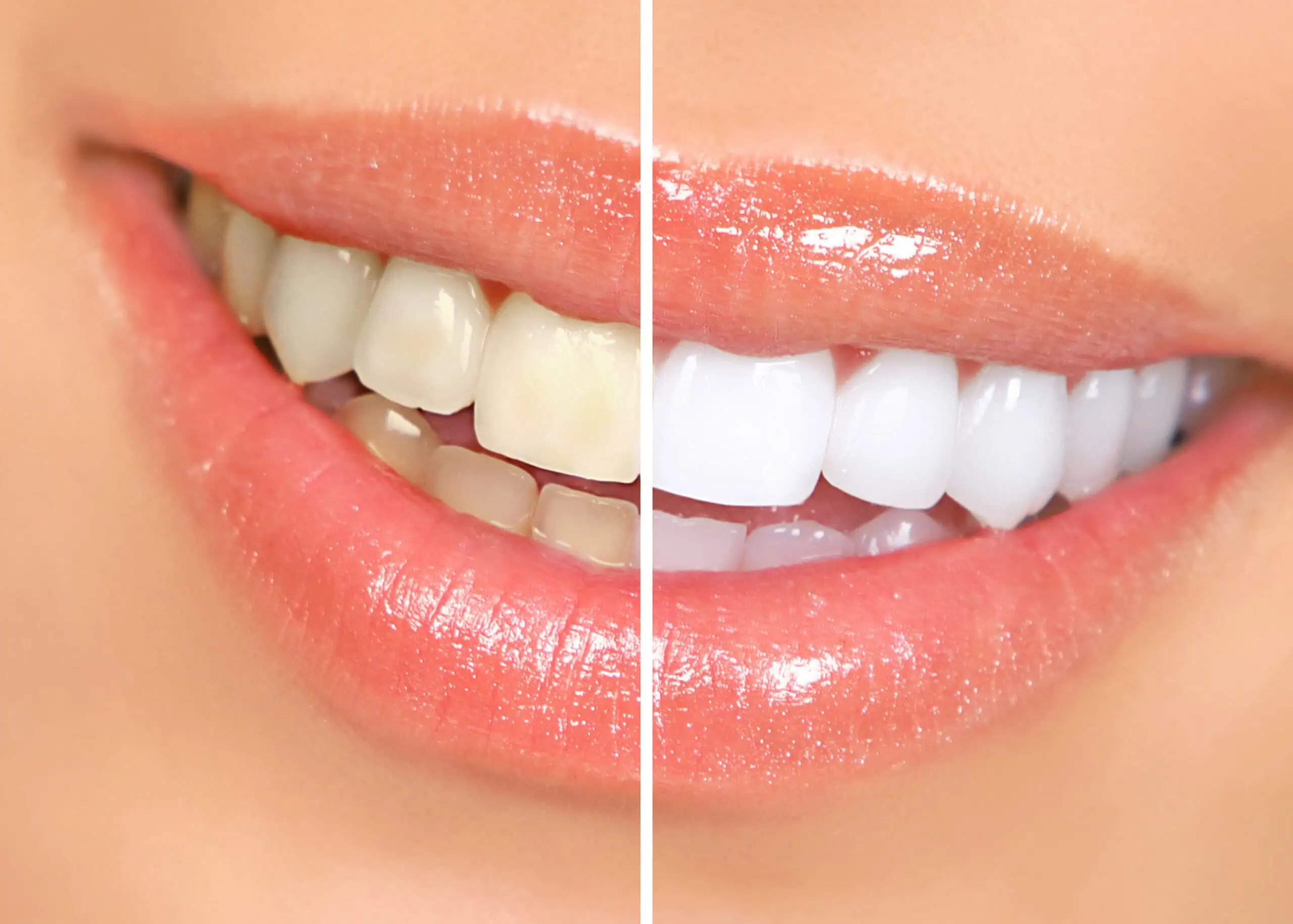 The Pros and Cons of Teeth Whitening