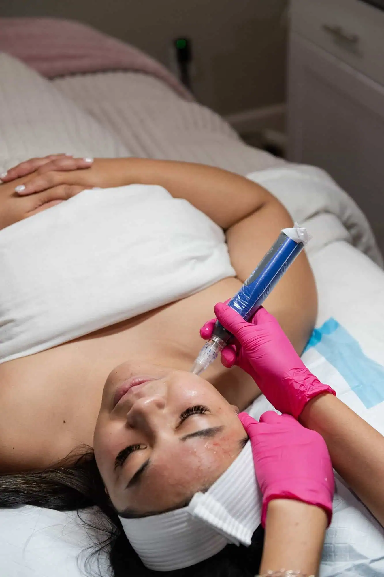 skinpen microneedling in Prescott Valley,AZ