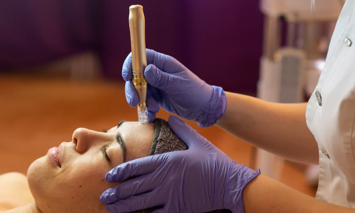 SkinPen microneedling treatment for smoother skin